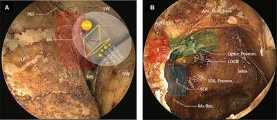 Traumatic oculomotor nerve palsy treated with transnasal endoscopic decompression through the optic strut